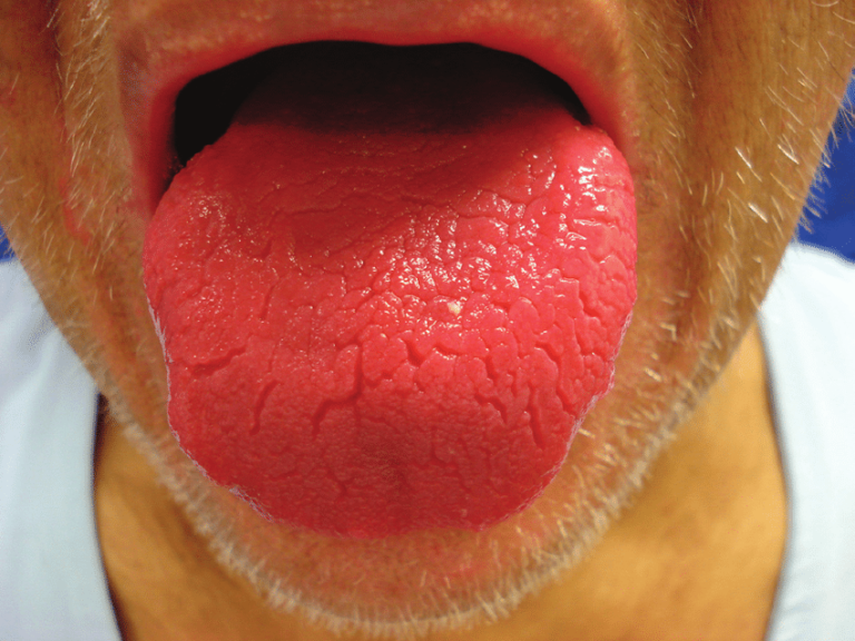 This Is What The Colour Of Your Tongue Says About Your Health – Page 2 Of 5